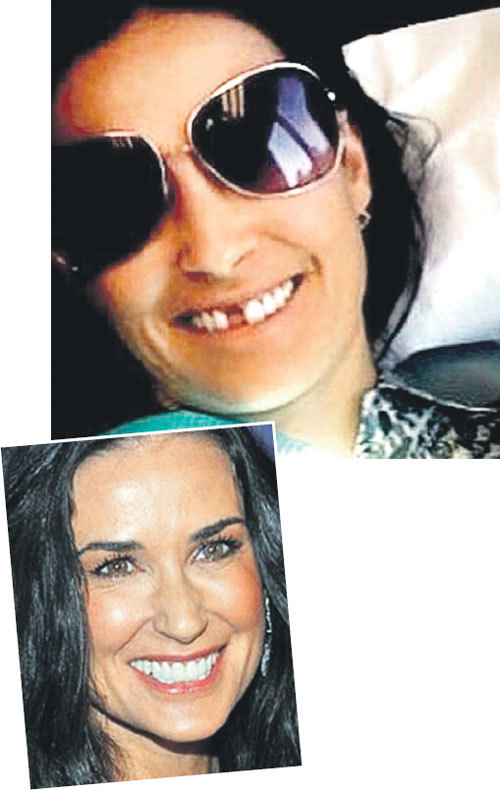 Деми МУР запечатлела себя перед процедурой имплантации переднего зуба. «Такова реальность», - подписала она это фото (Фото: topnews.ru)